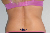 Skin Care Birmingham - Exilis® Laser Treatment  18