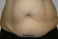 Skin Care Birmingham - Exilis® Laser Treatment  19