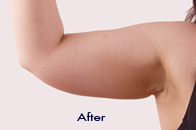 Skin Care Birmingham - Exilis® Laser Treatment  02