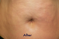 Skin Care Birmingham - Exilis® Laser Treatment  20