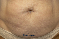 Skin Care Birmingham - Exilis® Laser Treatment  21