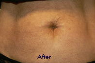 Skin Care Birmingham - Exilis® Laser Treatment  22