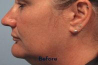 Skin Care Birmingham - Exilis® Laser Treatment  25