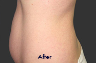 Skin Care Birmingham - Exilis® Laser Treatment  28