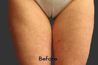 Skin Care Birmingham - Exilis® Laser Treatment  29