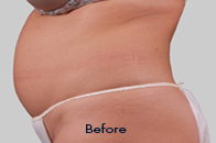 Skin Care Birmingham - Exilis® Laser Treatment  03
