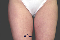 Skin Care Birmingham - Exilis® Laser Treatment  30