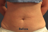 Skin Care Birmingham - Exilis® Laser Treatment  31