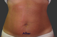 Skin Care Birmingham - Exilis® Laser Treatment  32