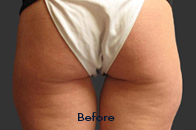 Skin Care Birmingham - Exilis® Laser Treatment  33