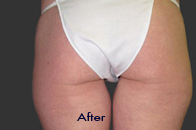 Skin Care Birmingham - Exilis® Laser Treatment  34
