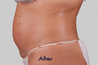 Skin Care Birmingham - Exilis® Laser Treatment  04