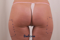 Skin Care Birmingham - Exilis® Laser Treatment  05