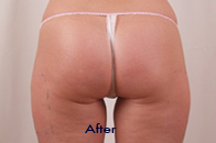Skin Care Birmingham - Exilis® Laser Treatment  06