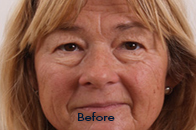 Skin Care Birmingham - Exilis® Laser Treatment  07