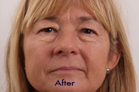 Skin Care Birmingham - Exilis® Laser Treatment  08