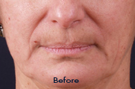 Skin Care Birmingham - Exilis® Laser Treatment  09