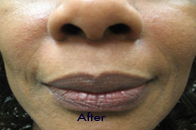 Skin Care Birmingham - Juvederm  02