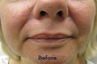 Skin Care Birmingham - Juvederm  03