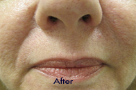 Skin Care Birmingham - Juvederm  04