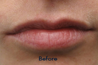 Skin Care Birmingham - Juvederm  05