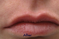 Skin Care Birmingham - Juvederm  06