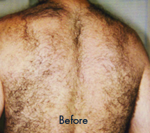 Skin Care Birmingham - Laser Hair Removal 03