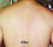 Skin Care Birmingham - Laser Hair Removal 04