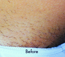 Skin Care Birmingham - Laser Hair Removal 05