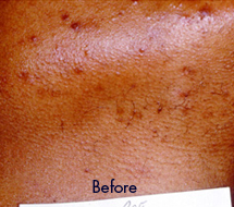 Skin Care Birmingham - Laser Hair Removal 07