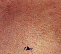 Skin Care Birmingham - Laser Hair Removal 08