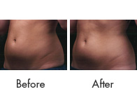 Liposonix Treatment Birmingham - Liposonix Before and After  01