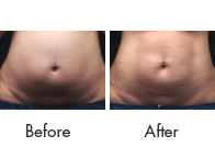 Liposonix Treatment Birmingham - Liposonix Before and After  02