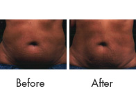 Liposonix Treatment Birmingham - Liposonix Before and After  03
