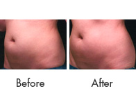 Liposonix Treatment Birmingham - Liposonix Before and After  04
