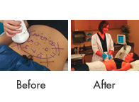 Liposonix Treatment Birmingham - Liposonix Before and After  05