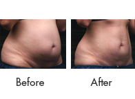 Liposonix Treatment Birmingham - Liposonix Before and After  06