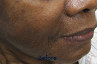 Skin Care Birmingham - Restylane  01