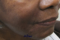 Skin Care Birmingham - Restylane  02