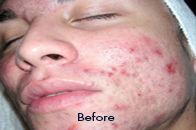 Skin Care Birmingham - SilkPeel1  01