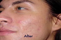 Skin Care Birmingham - SilkPeel1  02