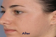 Skin Care Birmingham - SilkPeel1  04