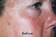 Skin Care Birmingham - SilkPeel1  05