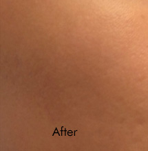 Fraxel Birmingham - After Fraxel Laser  Treatment 02