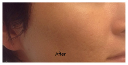Fraxel Birmingham - After Fraxel Laser  Treatment 03