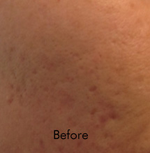 Fraxel Birmingham - Before Fraxel Laser  Treatment 02