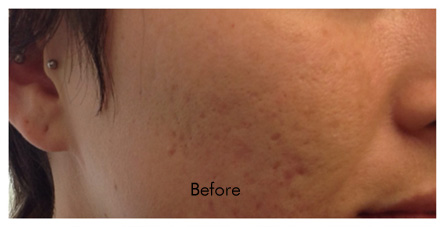 Fraxel Birmingham - Before Fraxel Laser  Treatment 03