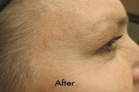 Skin Care Birmingham - Botox / Dysport  10