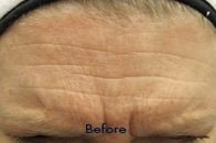 Skin Care Birmingham - Botox / Dysport  11