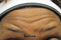 Skin Care Birmingham - Botox / Dysport  15